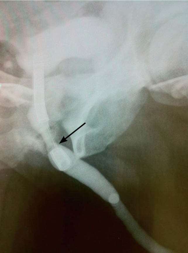 Рентгенологическая картина после установки уретральной спирали и слинга Argus