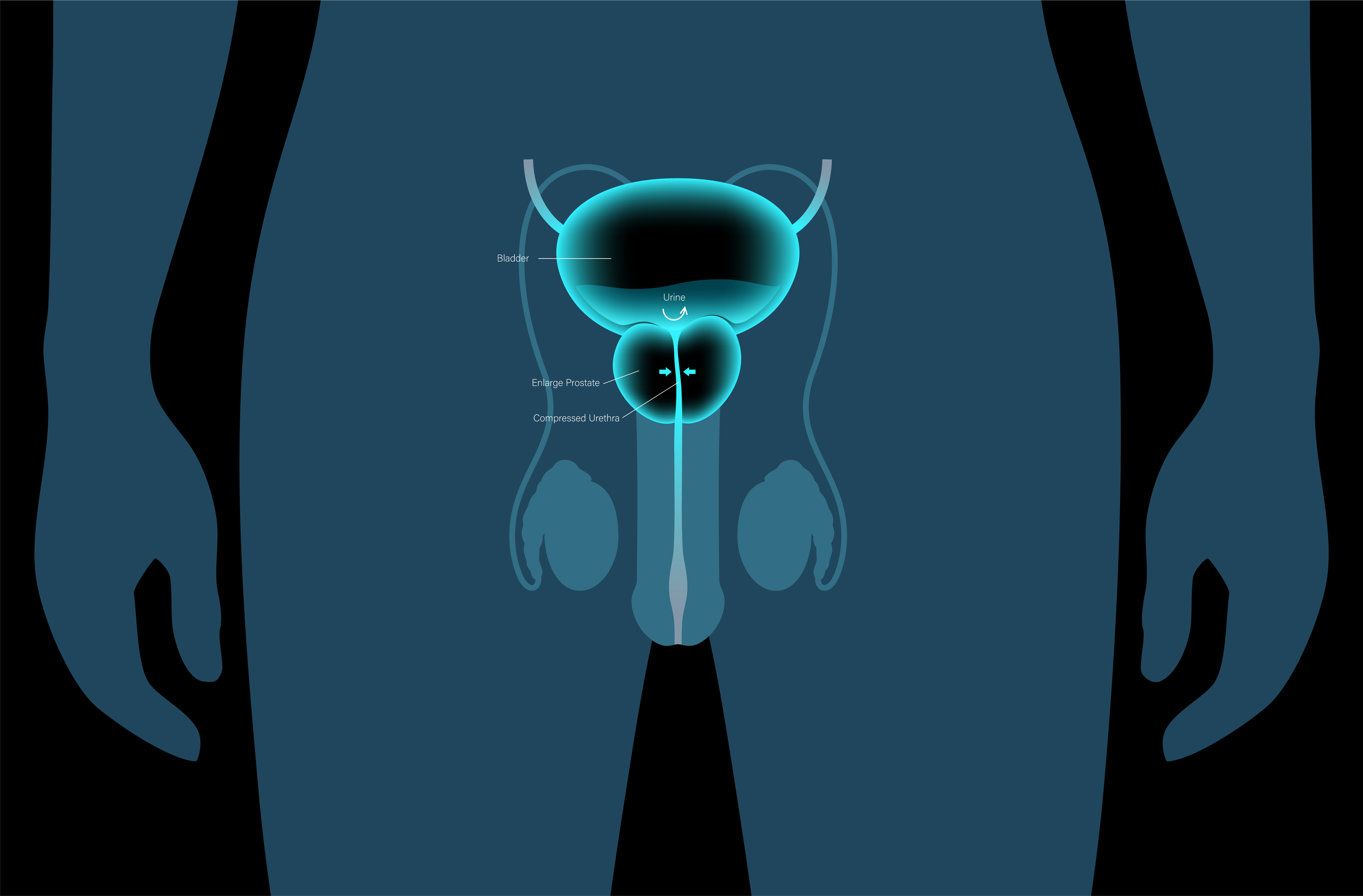 Что такое мини-инвазивная инъекционно-паровая терапия Rezūm и как она лечит ДГПЖ